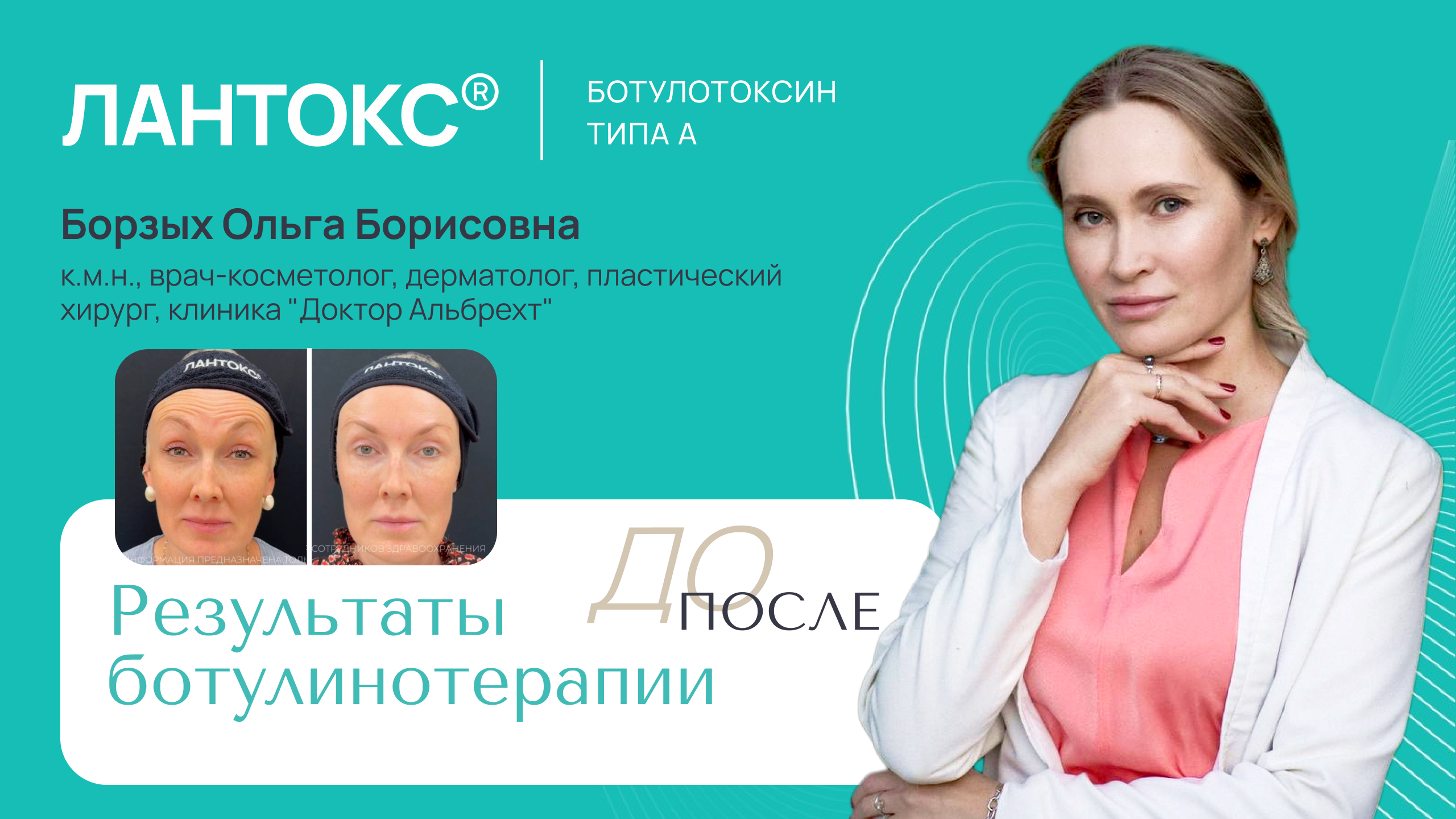 Мастер-класс: Мелкоморщинистый тип старения — сочетанная коррекция ботулиническим нейропротеином ЛАНТОКС® и коллагенотерапией COLLOST® micro